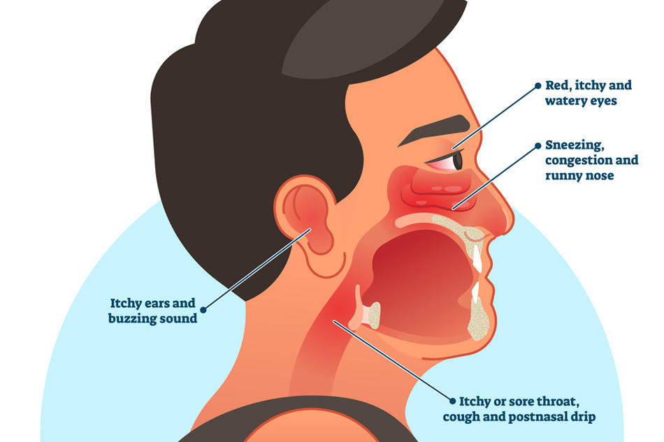 Các triệu chứng viêm mũi dị ứng