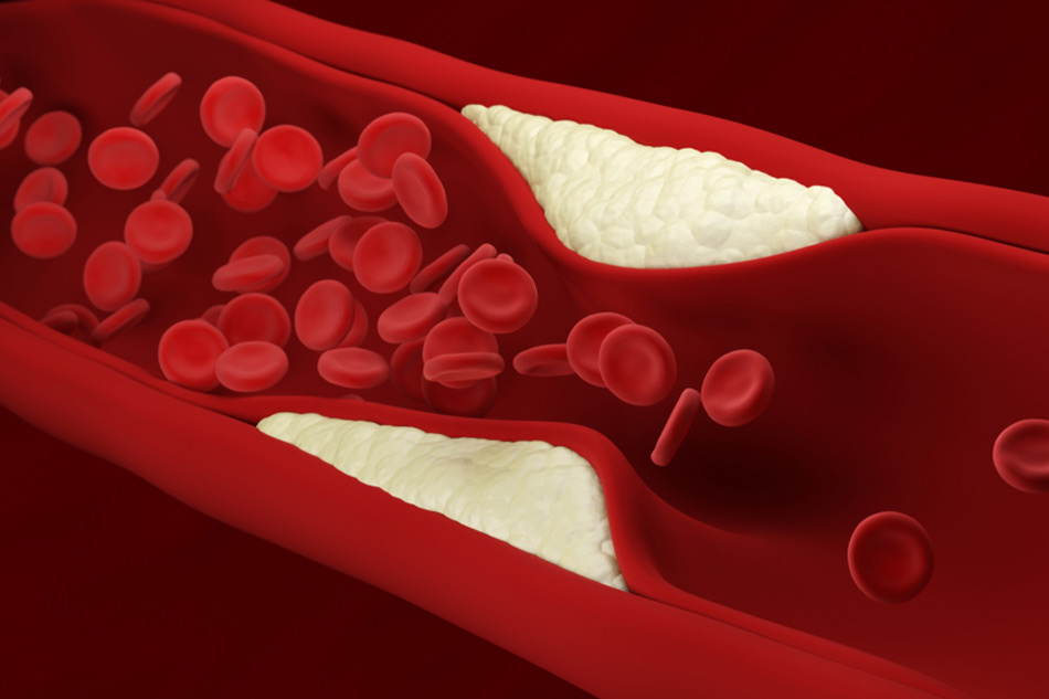 Thuốc Nasrix điều trị cholesterol máu tăng